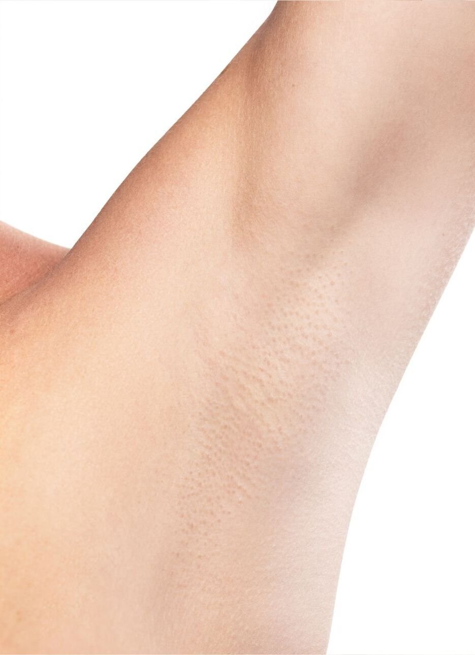 Depilación Láser Depilacion Laser Axilas Despues 1