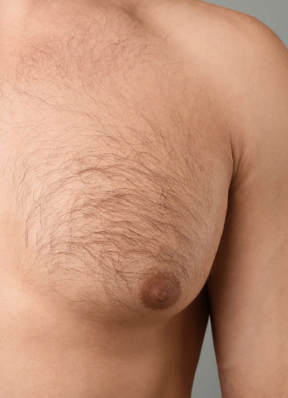 Depilación Láser Depilacion Laser Pecho Antes Rotated