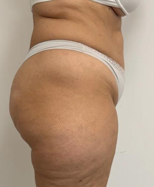 Tratamiento Corporal Despues