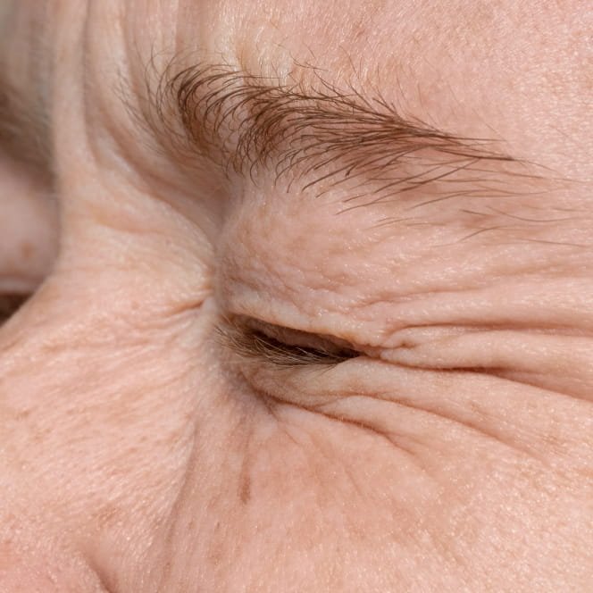 arrugas lineas de expresion