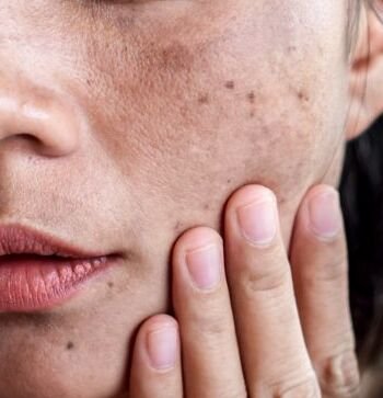 manchas cicatrices piel (2)